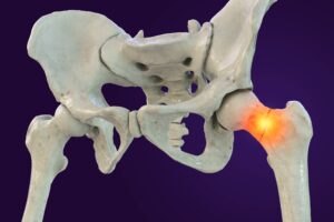 A fracture of the femur neck, a common type of hip fracture that typically occurs in older adults and can lead to mobility issues and other complications, 3D illustration, Stock-photo